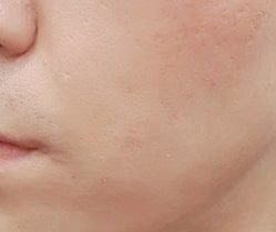 여드름 흉터 치료 후