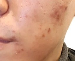 여드름 흉터 치료 전