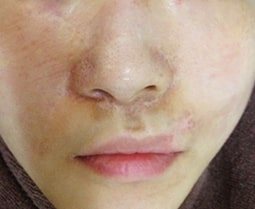 사고 흉터 치료 전 (Before)