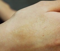 화상 흉터 치료 후 (After)