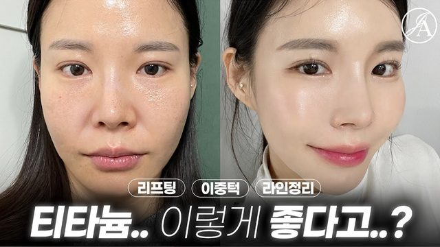 [DR.Choi_CASE LAB]최근 대세 리프팅은 바로 이것!? 영상 썸네일
